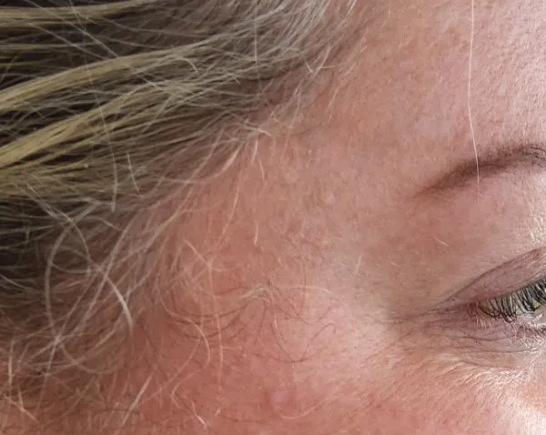 Anti-Wrinkle Injections — Crow's feet — after treatment