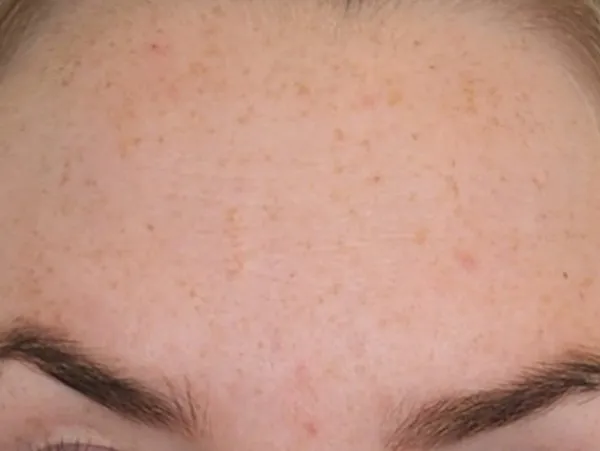 Anti-Wrinkle Injections — Forehead lines — after treatment