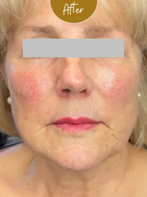 Biostimulators — Facial rejuvenation with Juvelook — after treatment