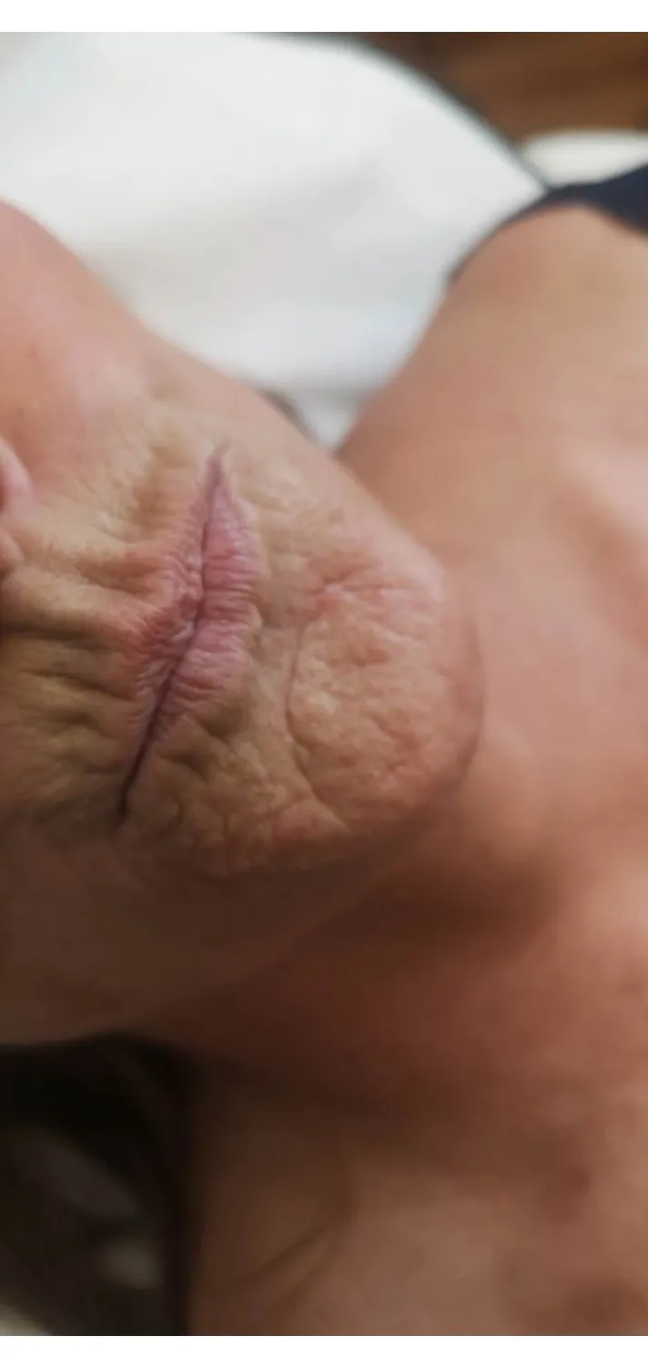 Dermal Fillers — Lines around the mouth — before treatment