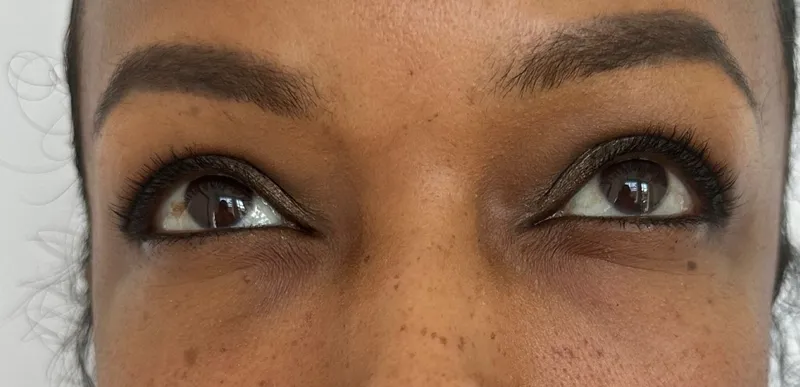 Skin Boosters — Under-eye area — after treatment