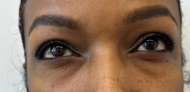 Skin Boosters — Under-eye area — before treatment