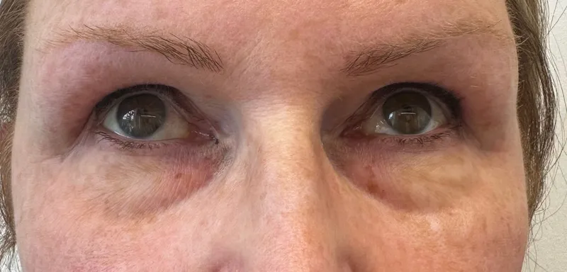 Skin Boosters — Under-eye area — after treatment