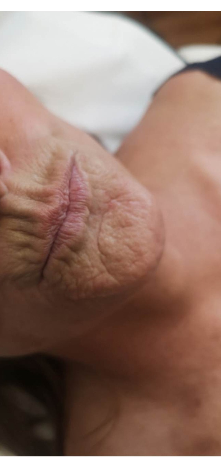 Dermal Fillers — Lines around the mouth — before treatment
