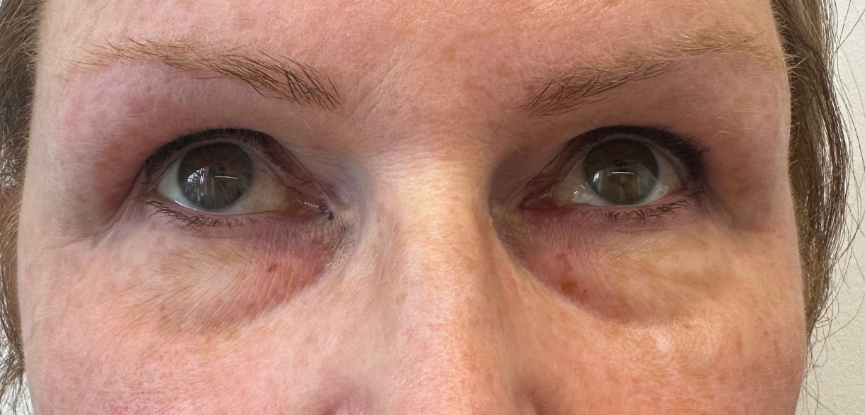 Skin Boosters — Under-eye area — after treatment