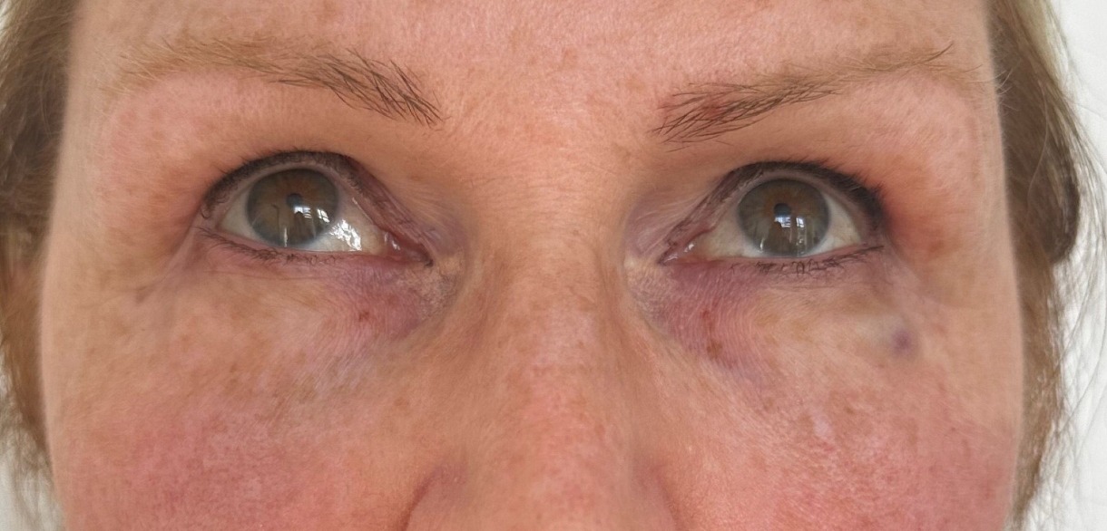 Skin Boosters — Under-eye area — before treatment