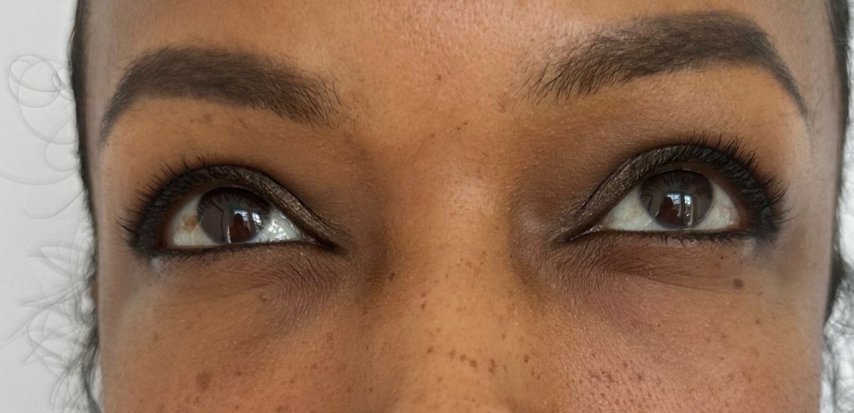 Skin Boosters — Under-eye area — after treatment