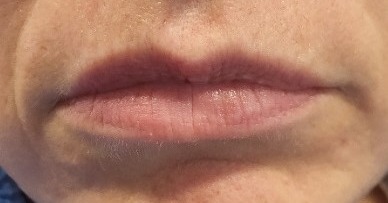 Dermal Fillers — Lip enhancement — before treatment