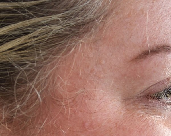 Anti-Wrinkle Injections — Crow's feet — after treatment
