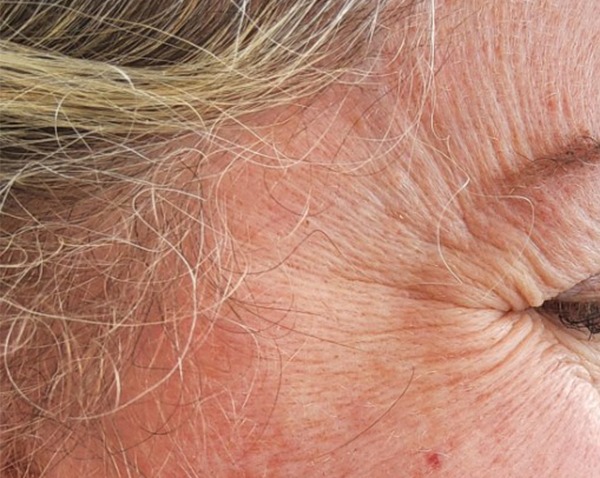 Anti-Wrinkle Injections — Crow's feet — before treatment