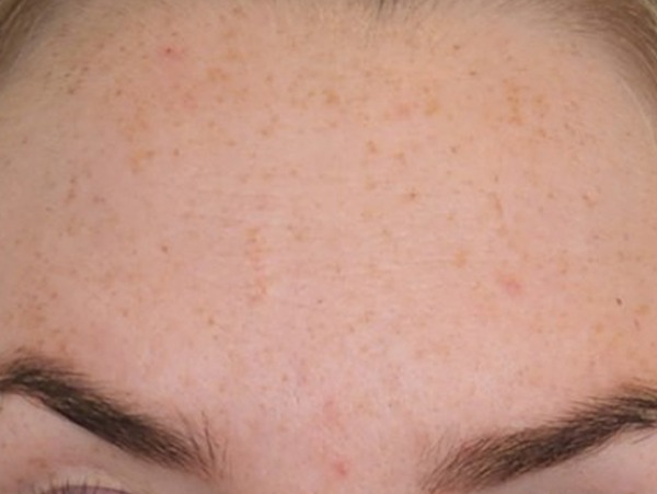 Anti-Wrinkle Injections — Forehead lines — after treatment