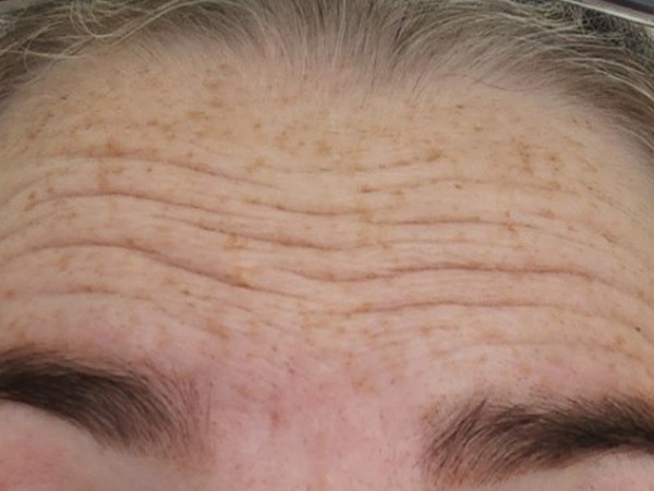 Anti-Wrinkle Injections — Forehead lines — before treatment