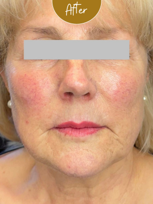 Biostimulators — Facial rejuvenation with Juvelook — after treatment