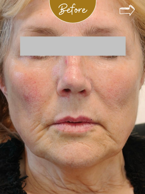 Biostimulators — Facial rejuvenation with Juvelook — before treatment