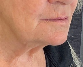 Sylfirm X — Lower face and neck — after treatment